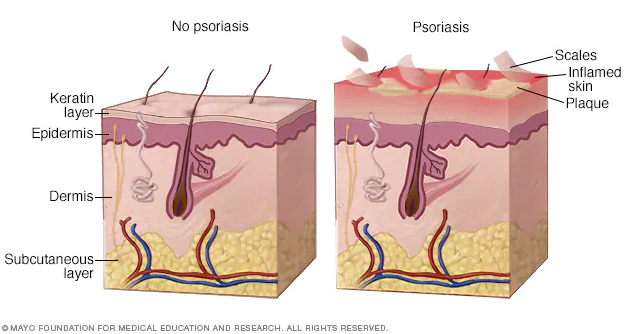 Psoriasis